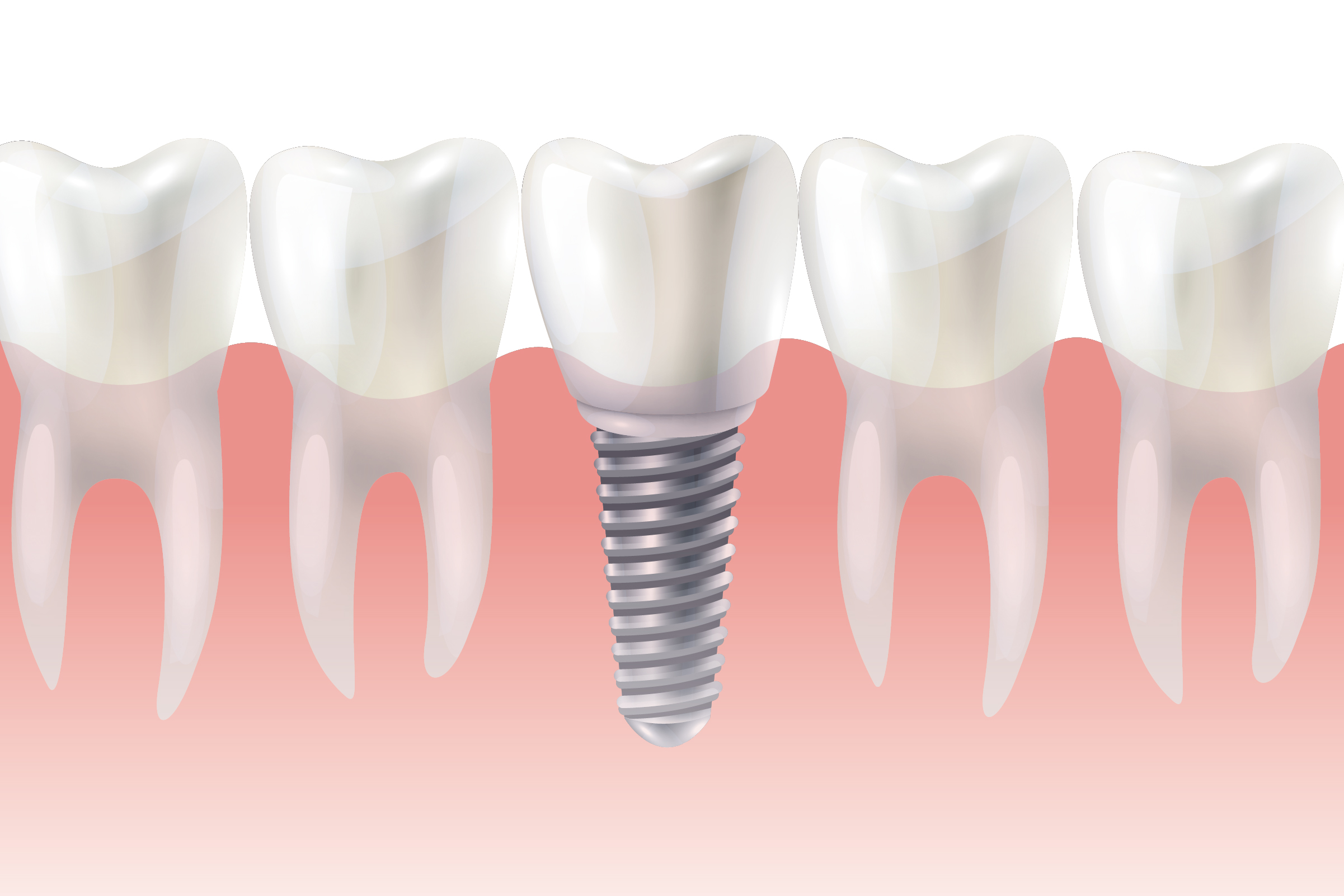 tipos de implantes dentales en Barcelona