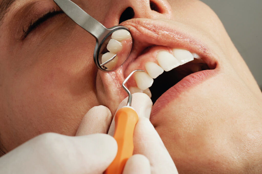 Limpieza dental anual en Barcelona