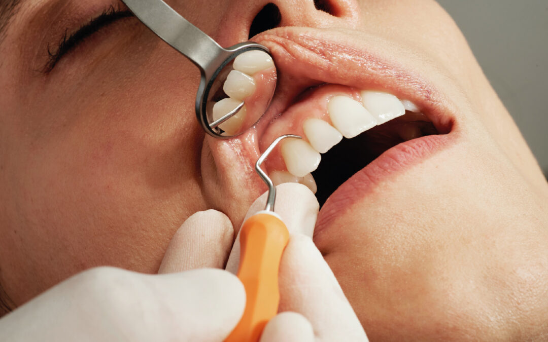 4 motivos para hacerse la limpieza y revisión dental anual.