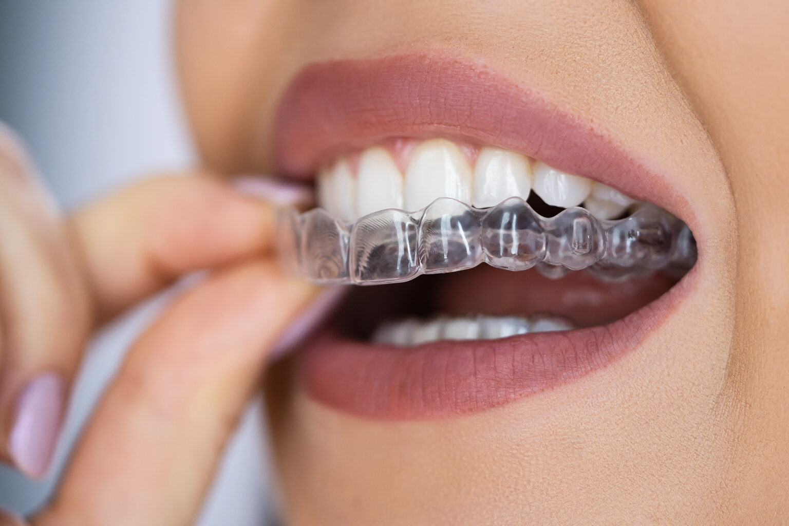 Persona colocándose alineadores invisibles usada para página de Ortodoncia Invisible Mydentiss