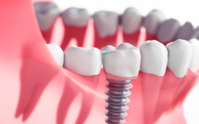 Implantes dentales: ¿qué son y para qué sirven?