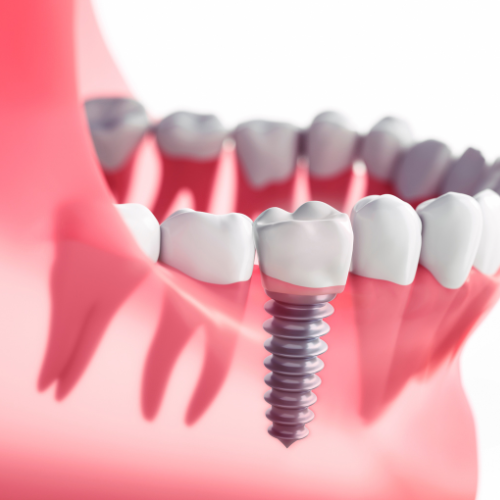 Implantes dentales: ¿qué son y para qué sirven?
