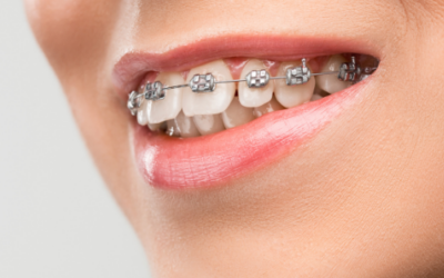 Ortodoncia: las claves sobre los brackets