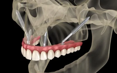 Implantes cigomáticos: Una solución revolucionaria en la odontología moderna
