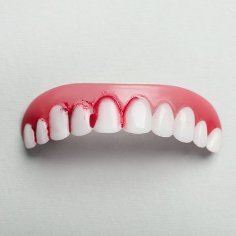 gingivitis