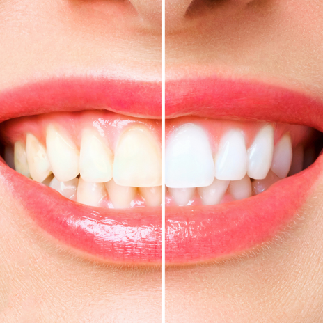 Tratamientos contra las manchas de los dientes