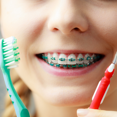 ¿Cómo cepillar tus dientes si llevas brackets?