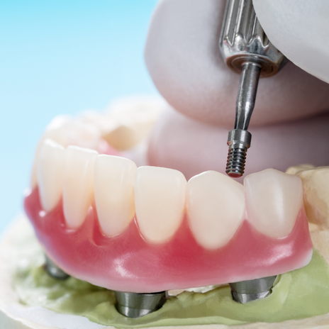 Diferencias claves entre los implantes dentales y las dentaduras postizas en Barcelona