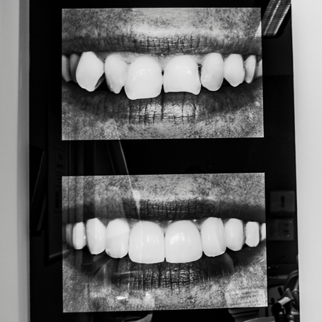 diseño de sonrisas en Barcelona