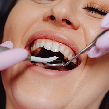 recontorneado incisal es un procedimiento dental cosmético en Poblenou