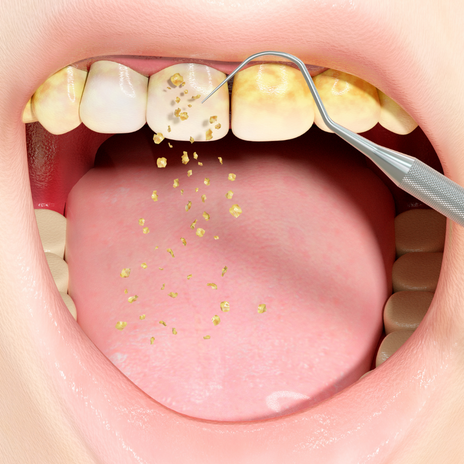 la periodontitis