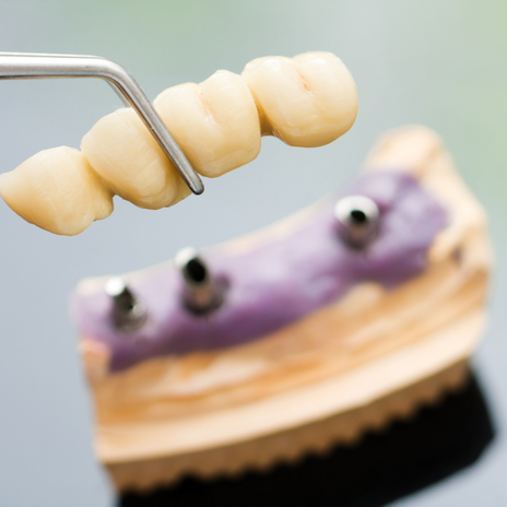 puentes dentales
