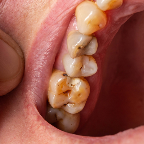 ¿Tienes dientes negros? Conoce las causas y los tratamientos
