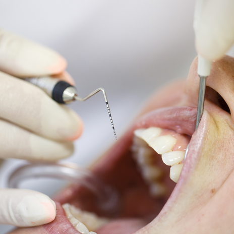 tratamientos de periodoncia en barcelona