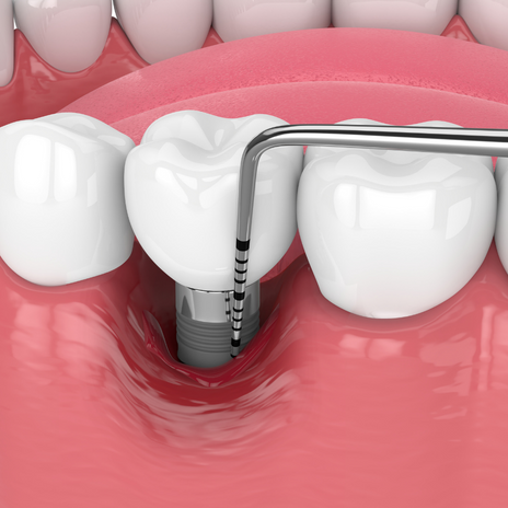periodoncia en barcelona