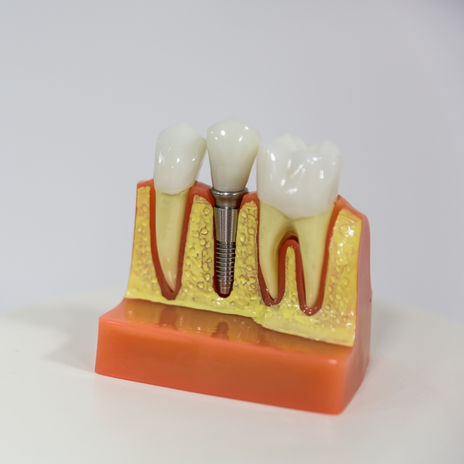 implante dental