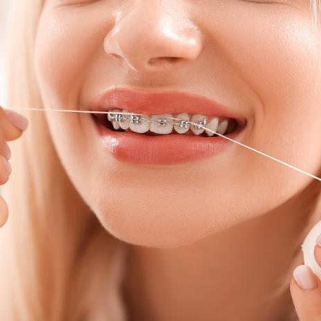 Imagen de chica con brackets pasándose hilo dental usada en página de ortodoncia Mydentiss