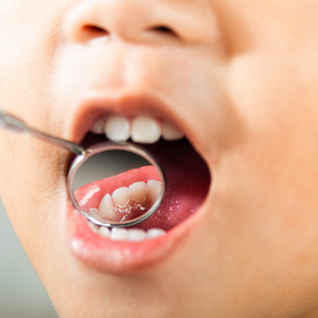 caries dentales