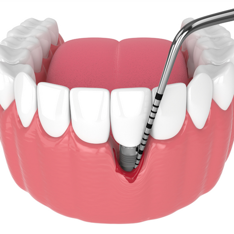 periimplantitis