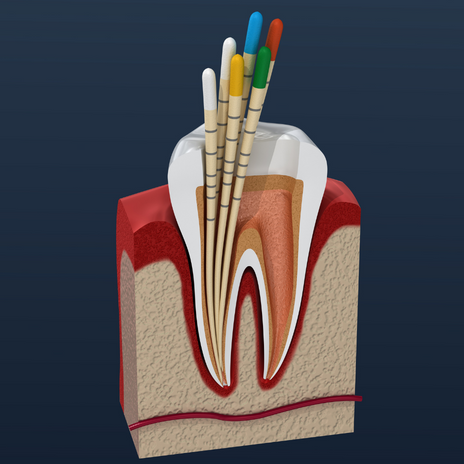 tratamiento de endodoncia en barcelona