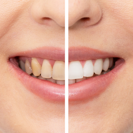 tratamiento para los dientes amarillos en barcelona