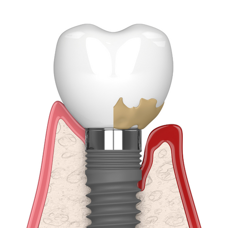 periimplantitis