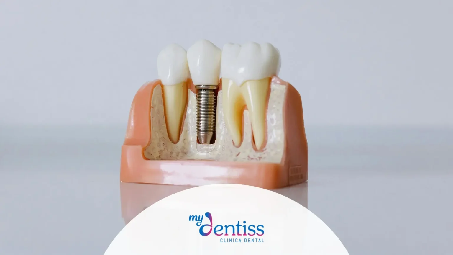 imagen de implante dental usada como fondo para blog de Mydentiss