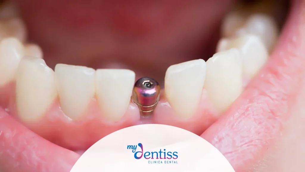 Imagen de una boca abierta enfocada en la encía inferior, donde se observa un implante dental metálico entre dos dientes naturales, utilizada como fondo de un blog de MyDentiss