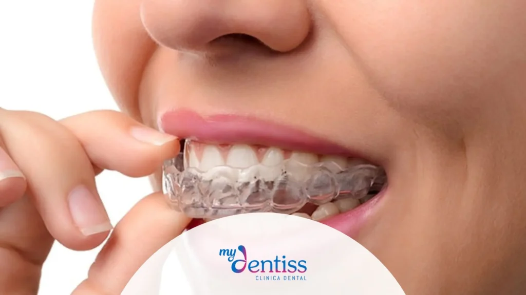 Imagen de una persona que se está colocando un alineador dental transparente (como Invisalign) en los dientes superiores, utilizada de fondo en un blog de MyDentiss