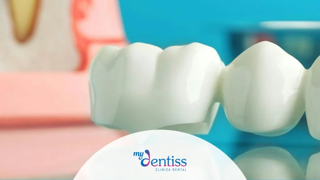 Imagen de dientes con fondo azul, usada como fondo para blog de Mydentiss: ¿Puente dental o implante? Qué opción es mejor para ti