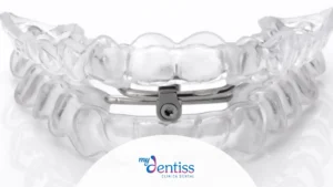 Imagen de un aparato dental transparente con un mecanismo metálico en el centro que tiene un tornillo de ajuste, utilizada como fondo de un blog de MyDentiss