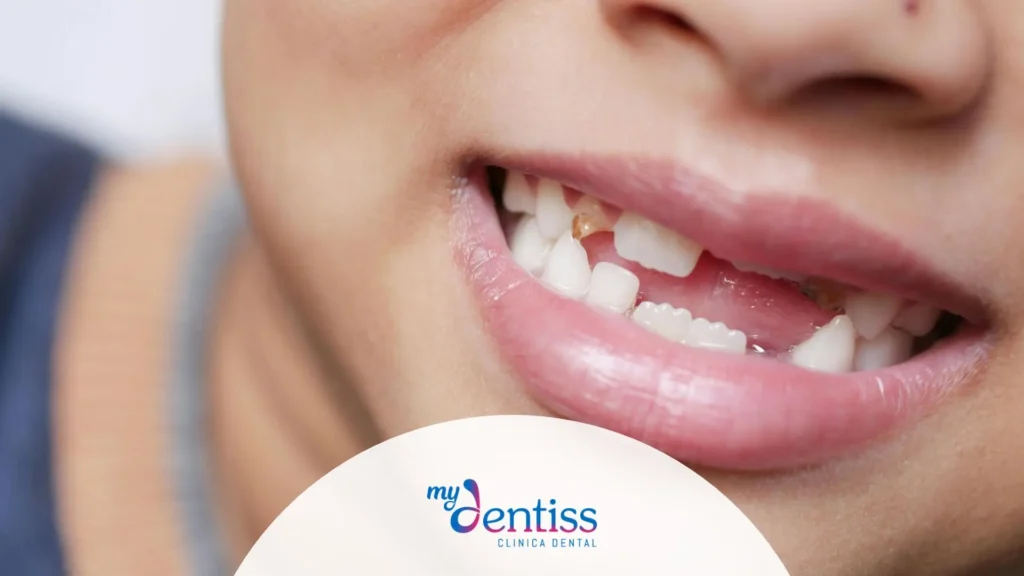 Imagen de niño que ha perdido dientes usada como fondo para Blog de Mydentiss: ¿Quién no es candidato para implantes dentales?