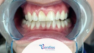 Imagen de una boca abierta con un separador dental transparente que permite ver claramente los dientes superiores e inferiores, utilizada como fondo en un blog de MyDentiss