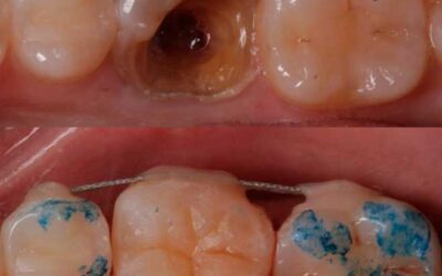 Autotrasplante dental: todo lo que necesitas saber para recuperar tu sonrisa natural