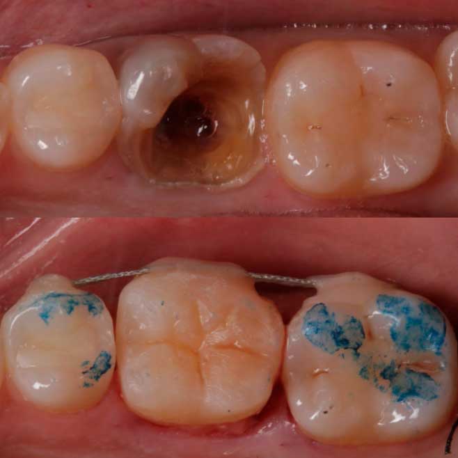Autotrasplante dental de molar