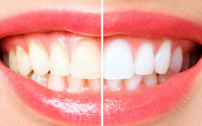 Estética dental: tipos de manchas en los dientes