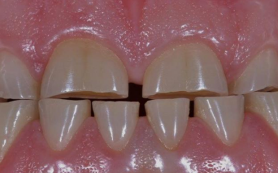 Atrición dental: Todo lo que necesitas saber