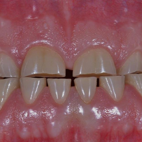 Atrición dental: Todo lo que necesitas saber
