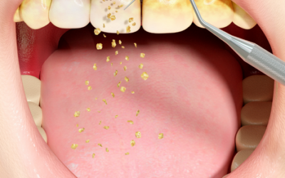 5 causas de la enfermedad periodontal