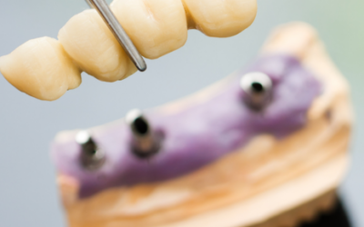 Pérdida dental: ¿Implantes o puentes dentales?