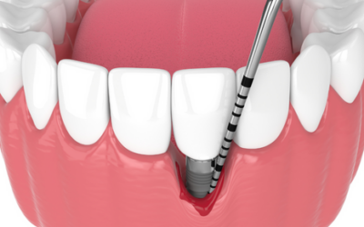 Implantes dentales: prevención de la periimplantitis