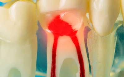 Gingivitis y periodontitis: diferencias principales