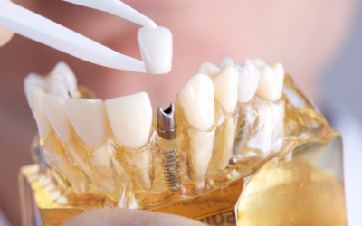 Cuidados en pacientes con implantes dentales