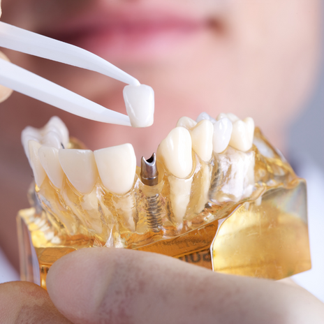 Cuidados en pacientes con implantes dentales