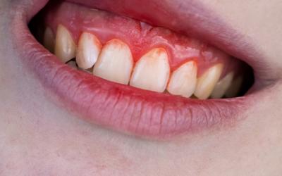¿Es normal el sangrado de las encías durante el cepillado?