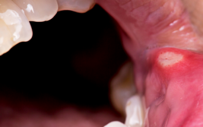 Llagas dentales: desentrañando sus causas, formación y tratamientos