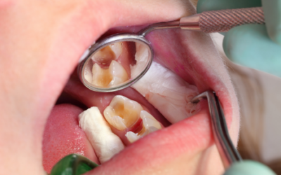Consejos para evitar la caries dental en niños