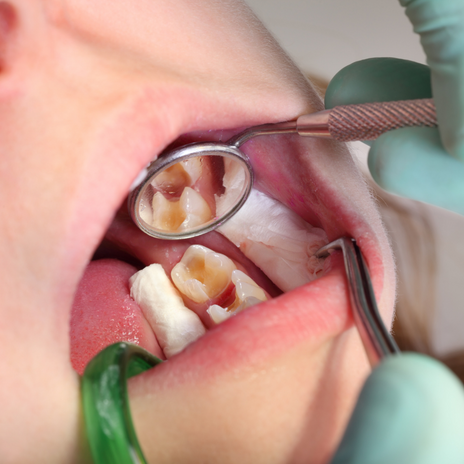Tratamientos para la caries dental