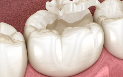 ¿Qué es el síndrome del diente fisurado?
