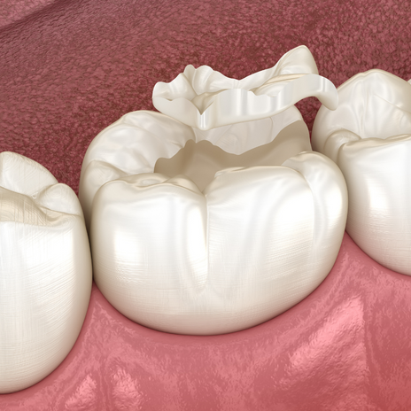 síndrome del diente fisurado